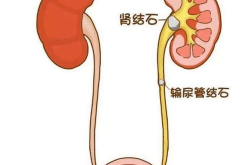 怎样缓解肾结石疼痛,肾结石疼痛缓解策略全解析